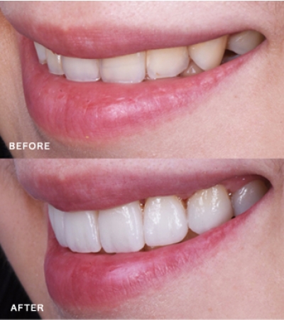 Smile Makeover with Veneer