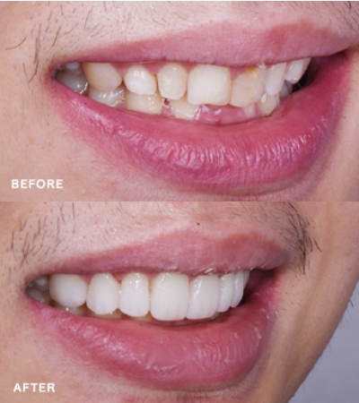 Smile Makeover with Veneer