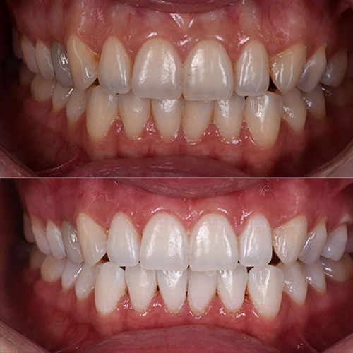 Before and After Dental Whitening 2