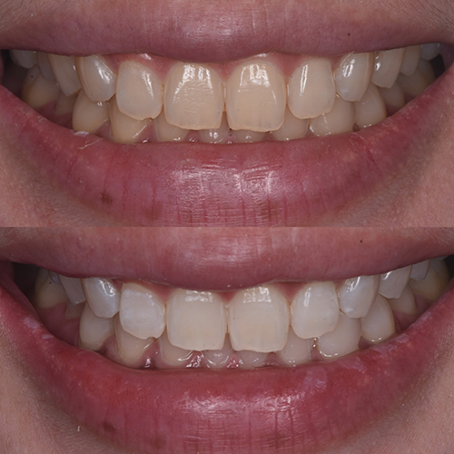 Before and After Dental Whitening