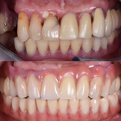 Before and After Dental Implant 1