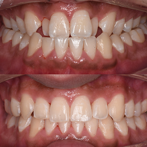 Before and After Invisalign Treatment 