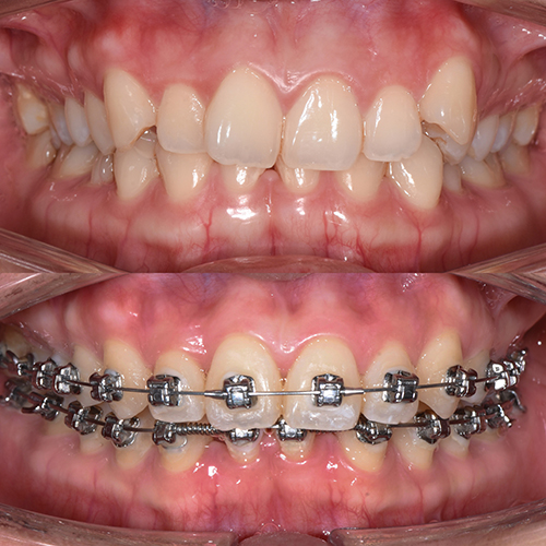 Before and After Orthodontic Treatment