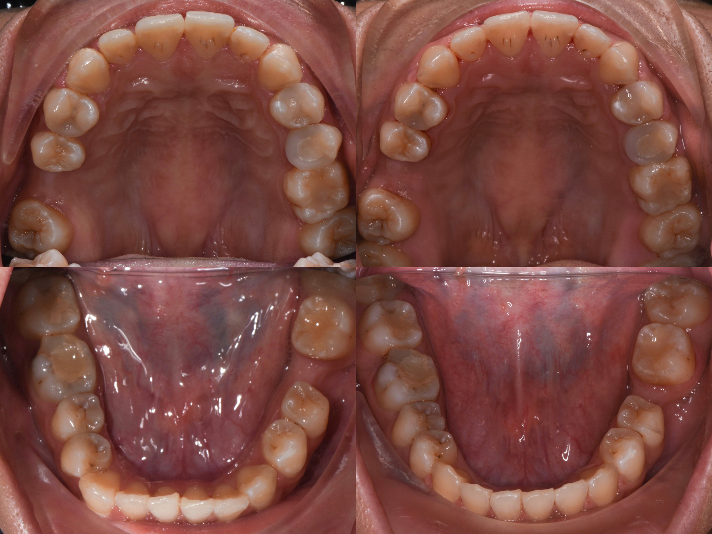 Before and After Orthodontic Treatment